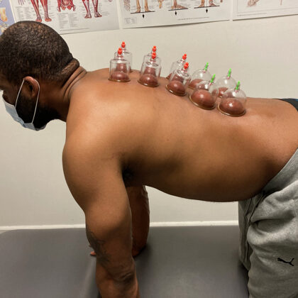 Cupping at Somatic Nature Physical Therapy and Wellness - Mission District